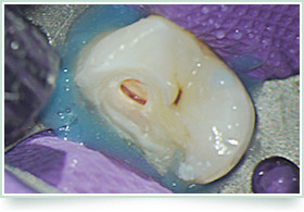 ばい菌が歯の中の神経につかないようにラバーダムを行います。